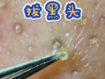 粉刺视频